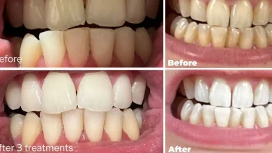 dentist-backed-95p-teeth-whitening-strips-purchasers-help-announcing-they’ll-‘aquire-again’