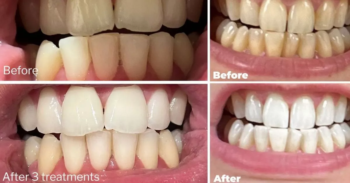 dentist-backed-95p-teeth-whitening-strips-purchasers-help-announcing-they’ll-‘aquire-again’