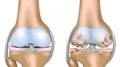 A new way of treating ordinary knee pain