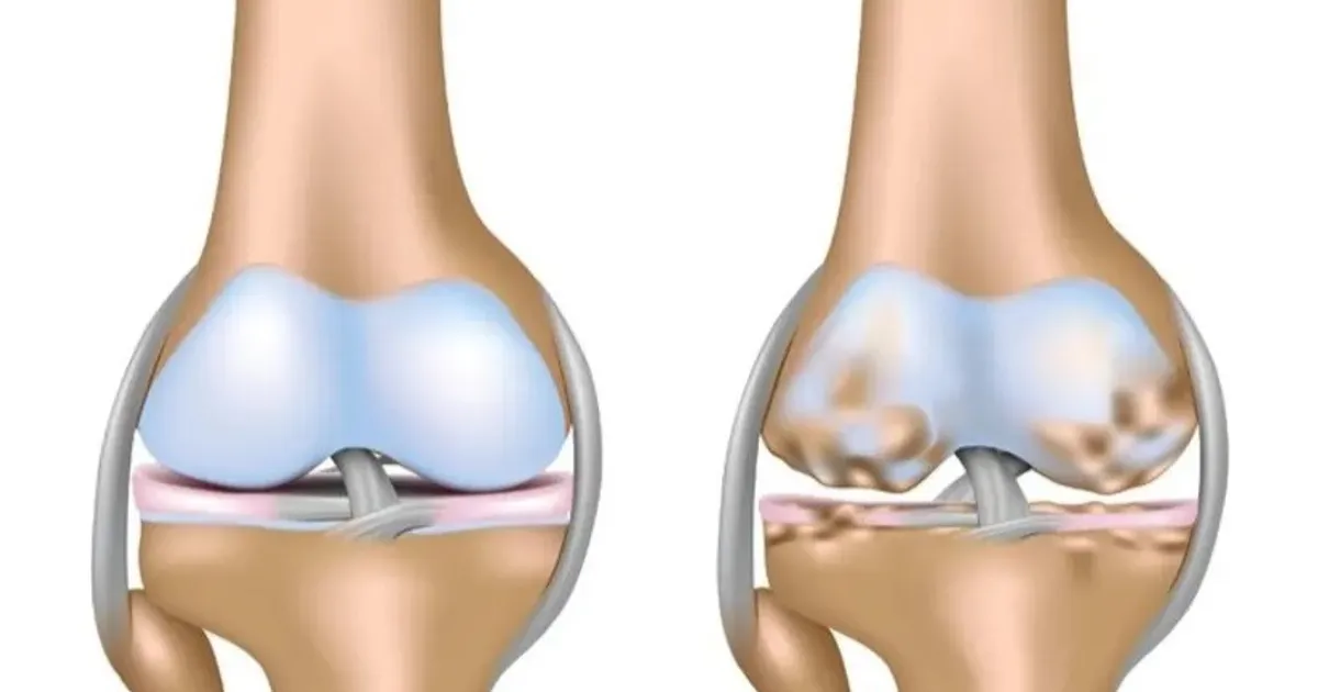 A new way of treating ordinary knee pain