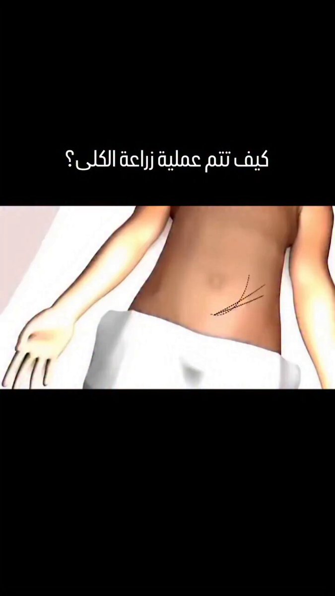كيف تتم عملية زراعة الكلي ؟