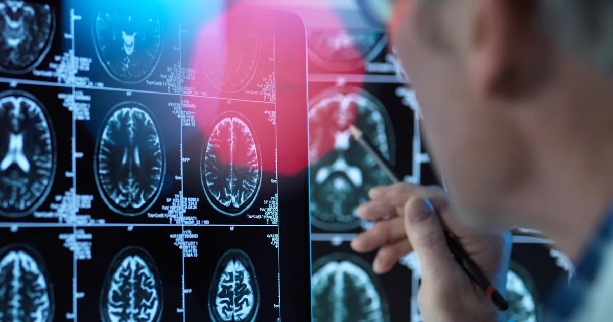 Study: The “Sugar” road in the brain reveals the secret of the treatment -resistant depression