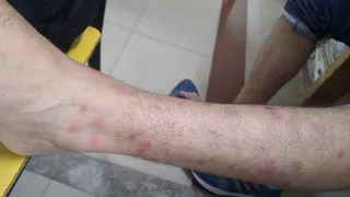 Battle bed bugs overnight! Hands and legs of the former flight engineer swollen in AC EXCEPTION room, negligence of Dhanbad station exposed -Dhanbad trace bed bedding in AC Room gear Bite in train exposes poor maintenance