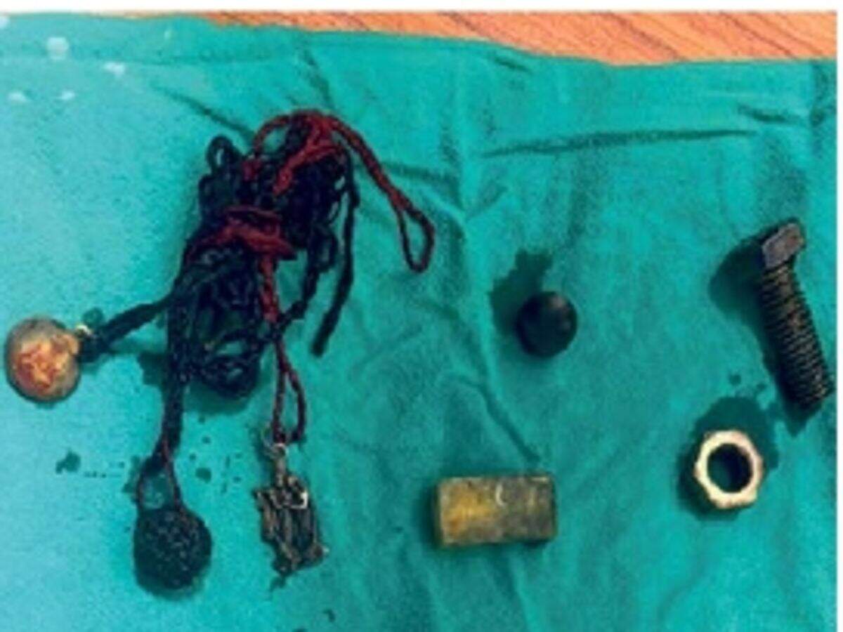 A watch and pieces of iron were removed from the stomach of a 34-year-old youth at Jaipur SMS Hospital.