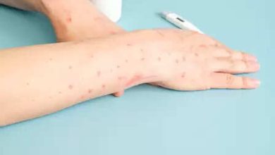 Access of monkeypox in maharashtra, first patient found in Dhule, Alert Health Department