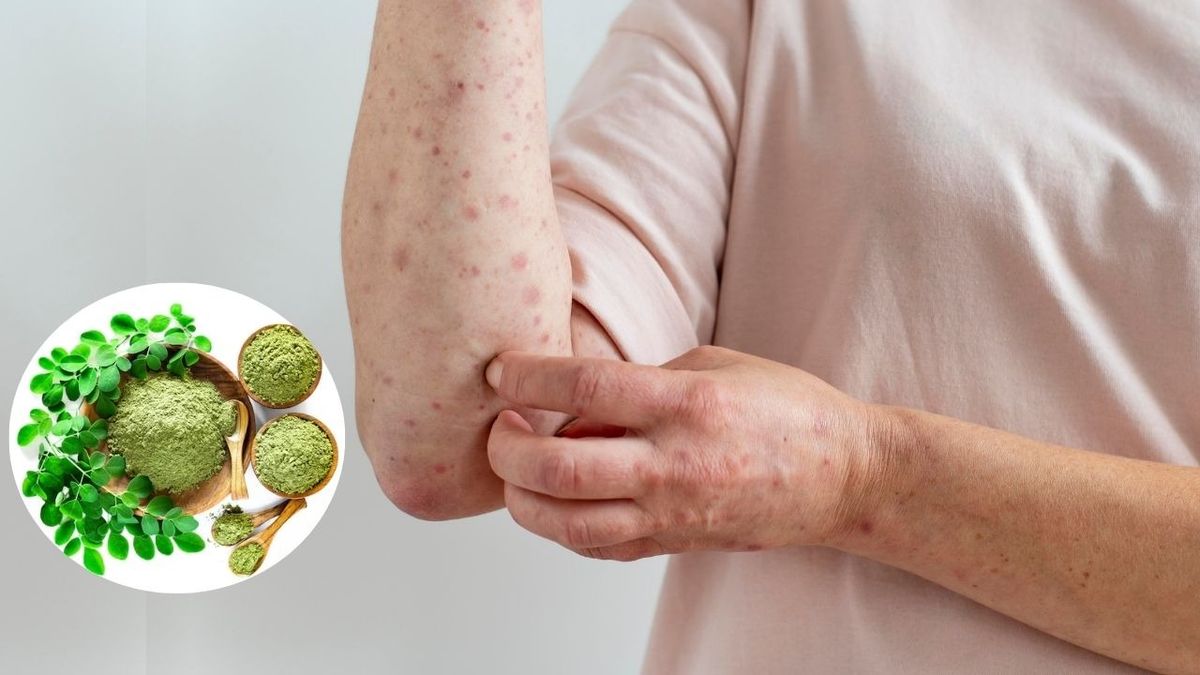त्वचा पर बार-बार खुजली या चकत्ता जैसा हो रहा? Moringa Powder का करें सेवन, मिलेंगे कई स्वास्थ्य लाभ
