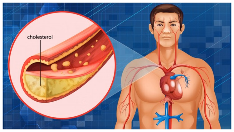 Cholestrol Risk:कोलेस्ट्रॉल बढ़ना सेहत के लिए खतरनाक, पर कोलेस्ट्रॉल होता क्या है ये जानते हैं आप? - What Is Cholesterol In Human Body How High Cholesterol Is Dangerous Tips To Control It
