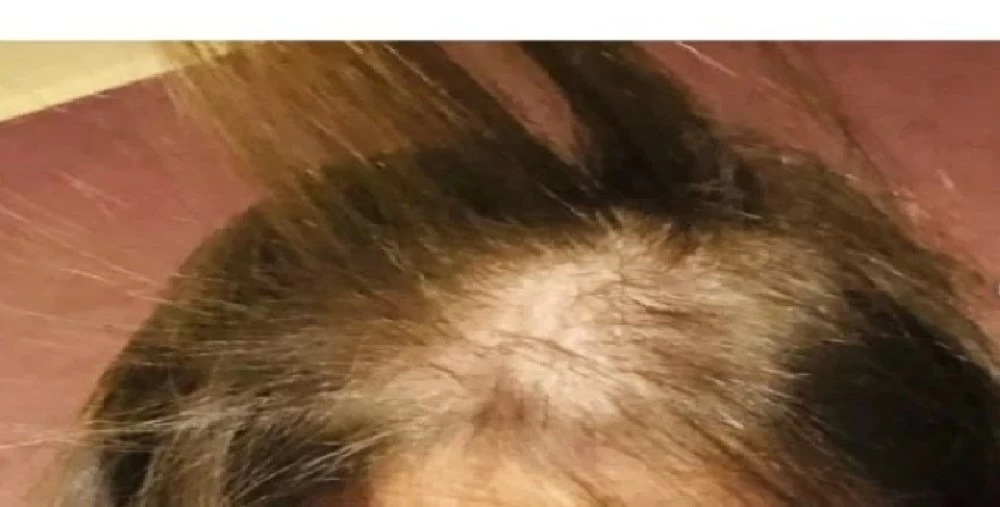 فنانة مصرية تفقد شعرها بعد جلسة تجميل فاشلة. للاطلاع على